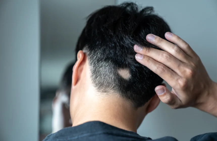 Expert solutions for alopecia hair loss at Natural Slim and Glow in Mumbai