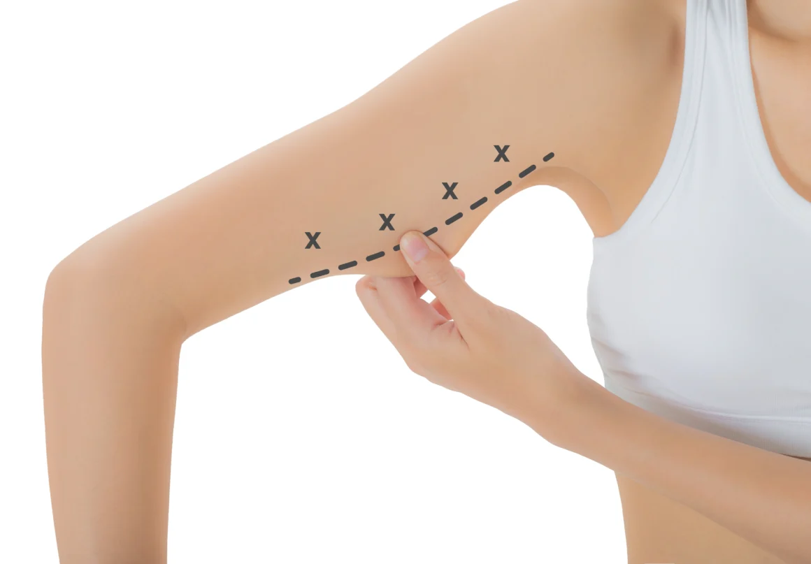 Enhance your arm's appearance with arm tuck surgery at Natural Slim and Glow in Mumbai.