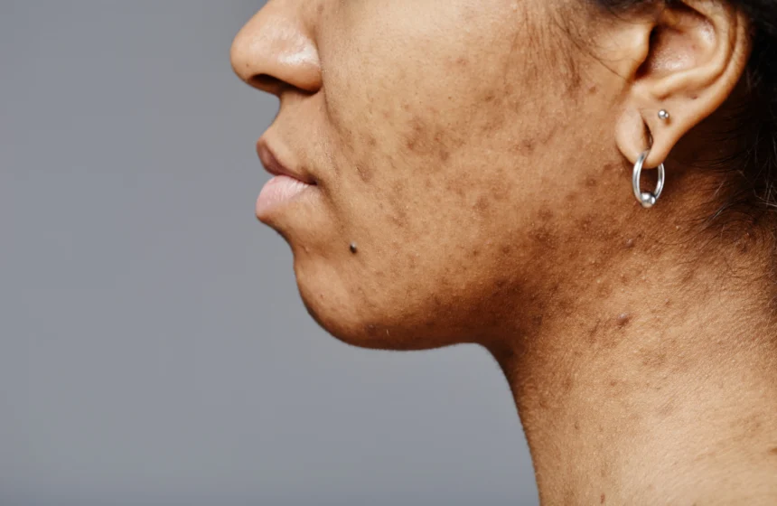 Advanced pigmentation treatment services at Mumbai's Natural Slim and Glow